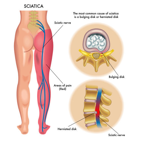 what cause sciatica nerve pain
